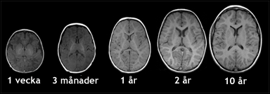 Hjärnans utveckling hos barnet