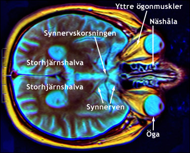 Synnnervskorset sedd med MR, magnetisk resonanstomografi