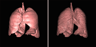 Datortomografi av människans lungor