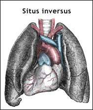 Situs inversus i brösthålan